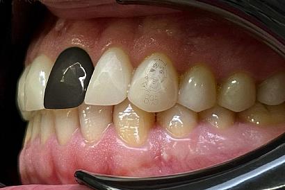 Новосибирец установил на зубах портрет Овечкина и «отсутствие зуба» в его стиле