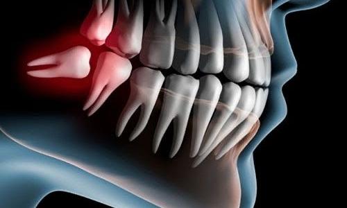 Нужны ли нам зубы мудрости? Стоматолог объясняет, когда их стоит удалять