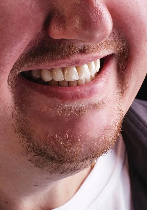 Ставить ли ювениры или виниры: как выбрать клинику и врача для установки коронок на зубы?